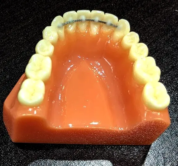 WHAT IS THE  Permanent Bonded Retainers