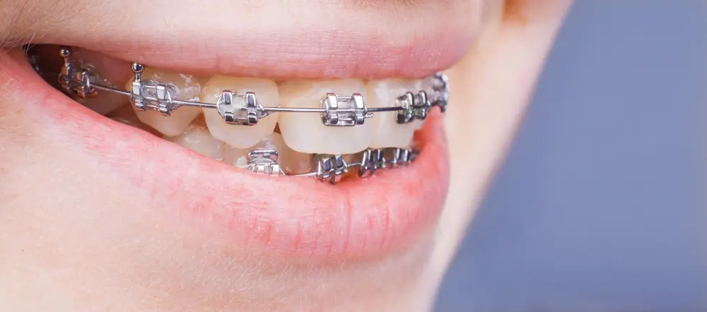 person wearing metal braces