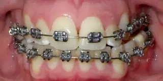 rsz smile with braces from orthodontists