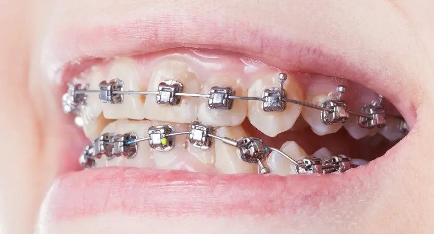 tratamiento de brackets autoligables