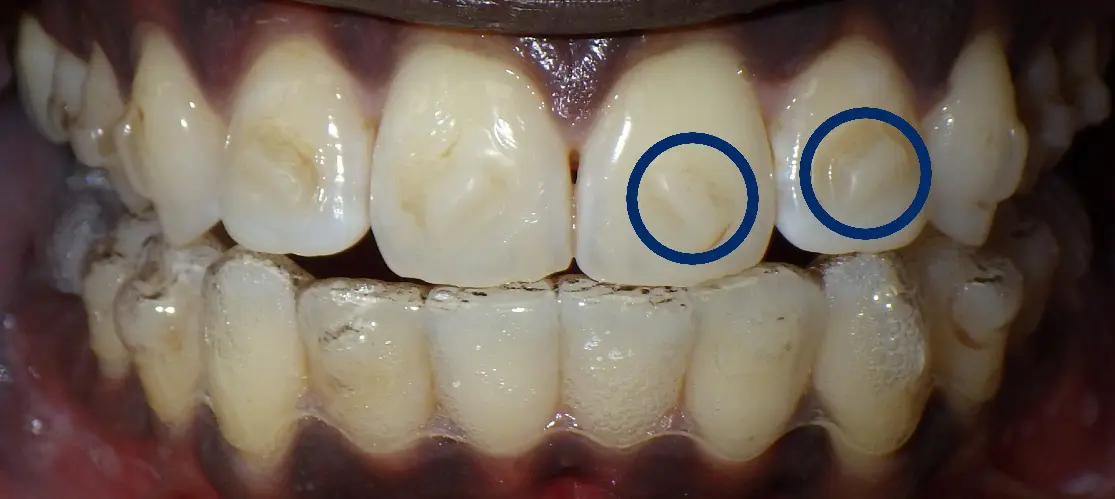 Only Invisalign Treatment Offers SmartForceâ„¢ Attachments