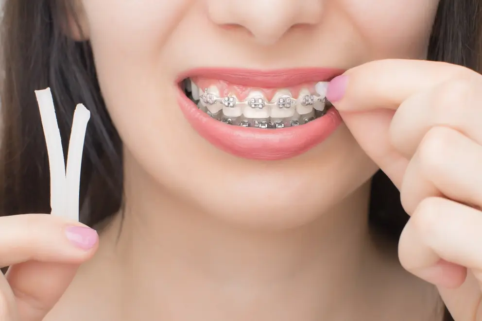 ARE YOU FEELING  Discomfort Because of Your Braces? Try Using Orthodontic Wax