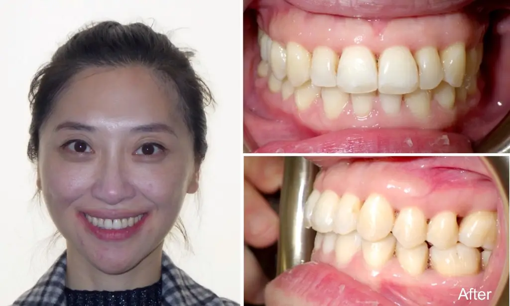 tingting  years old crossbite after invisalign treatment