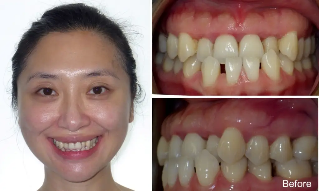 tingting  years old crossbite before invisalign treatment