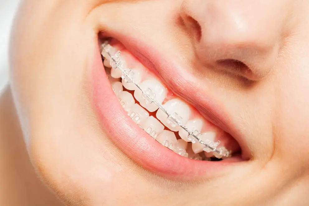 what are ceramic braces