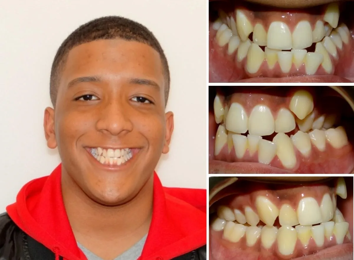 Invisalign Braces Before and After Review [VIDEO]