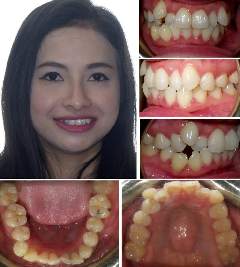 Crowding Teeth Invisalign