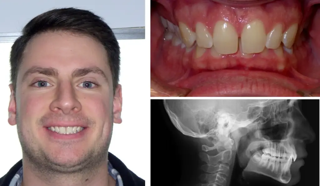 What is Overbite: Symptoms, Diagnosis and Treatment