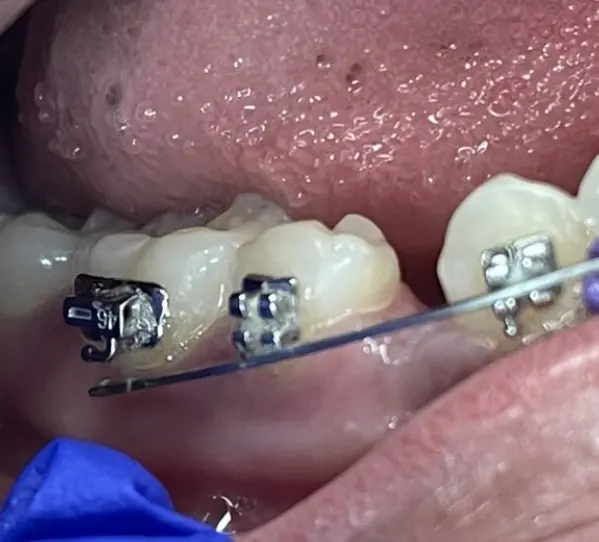 Tooth Managing Pain and Sores During Braces Treatment