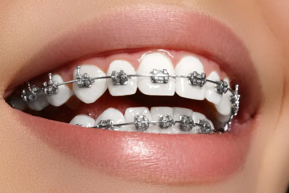 woman wearing braces before teeth relapse