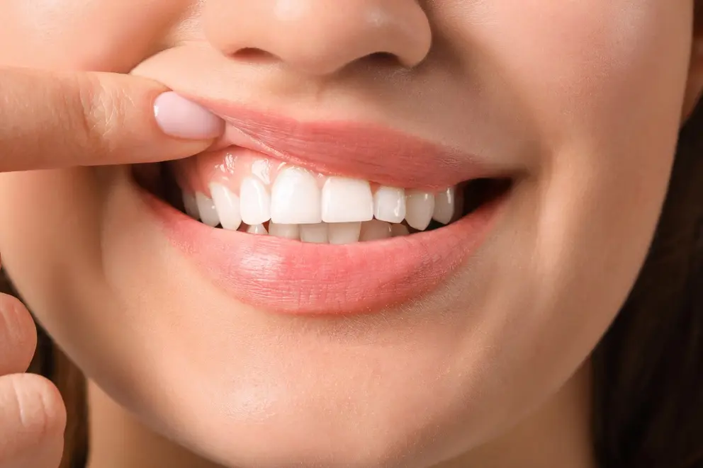 woman with healthy gums with clear aligners